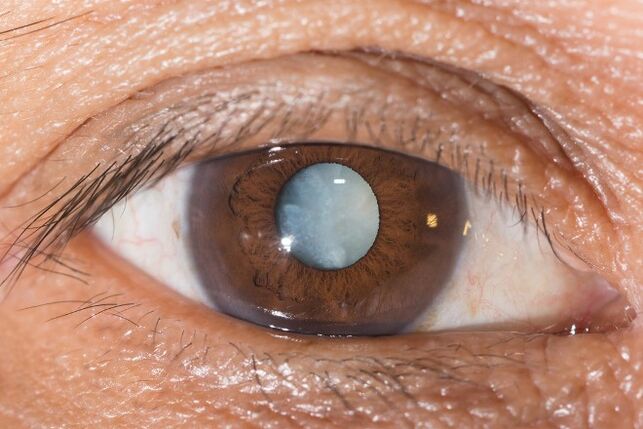 Pentru cataractă sunt indicate exerciții de îmbunătățire a vederii.